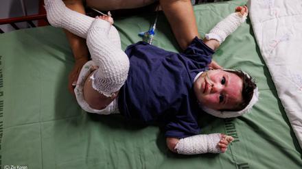 Aufnahme vom 24. Oktober 2023 aus Tel Hashomer, Ramat Gan, Israel. Die eineinhalb-jährige Yael Golan wurde am 7. Oktober zusammen mit ihren Eltern in Kfar Aza verletzt. 30 Prozent ihrer Haut ist verbrannt.