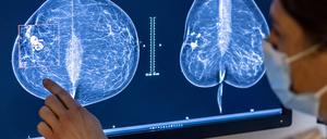 Medizinisches Personal untersucht mit einer Mammografie die Brust einer Frau auf Brustkrebs. Die Untersuchung soll bei der frühen Erkennung von Brustkrebs helfen.