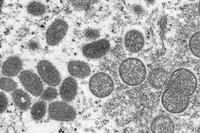 Diese elektronenmikroskopische Aufnahme aus dem Jahr 2003, die von den Centers for Disease Control and Prevention zur Verfügung gestellt wurde, zeigt reife, ovale Affenpockenviren (l) und kugelförmige unreife Virionen (r), die aus einer menschlichen Hautprobe im Zusammenhang mit dem Präriehundeausbruch von 2003 stammt. 
